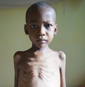 Dożywianie zagłodzonych w Mampikony (Madagaskar)