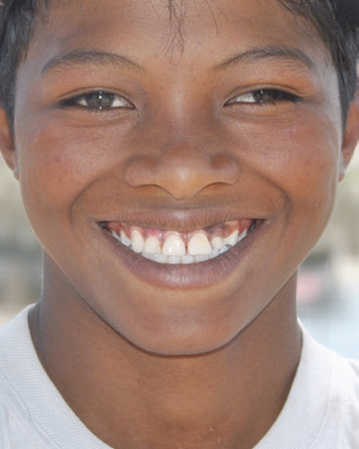 Dożywianie 310 wygłodzonych dzieci w Mampikony (Madagaskar)