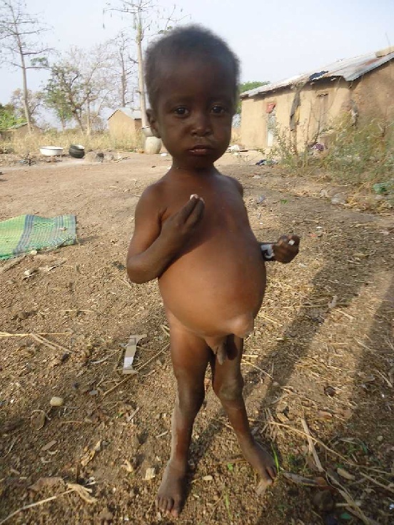 Leczenie i edukacja Johna (Togo)