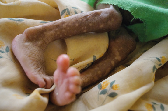Ratowanie życia niedożywionych dzieci w Mampikony (Madagaskar)