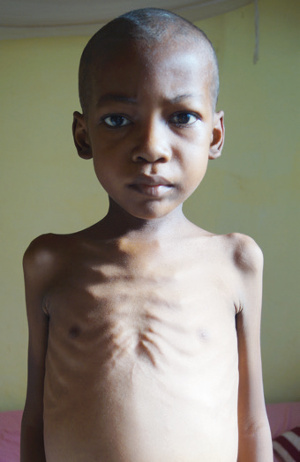 Tombozafy.Ratowanie życia niedożywionych dzieci w Mampikony (Madagaskar)